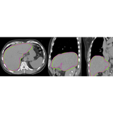 SurePlan™ LiverY90