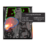 SurePlan™ LiverY90