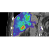 SurePlan™ LiverY90