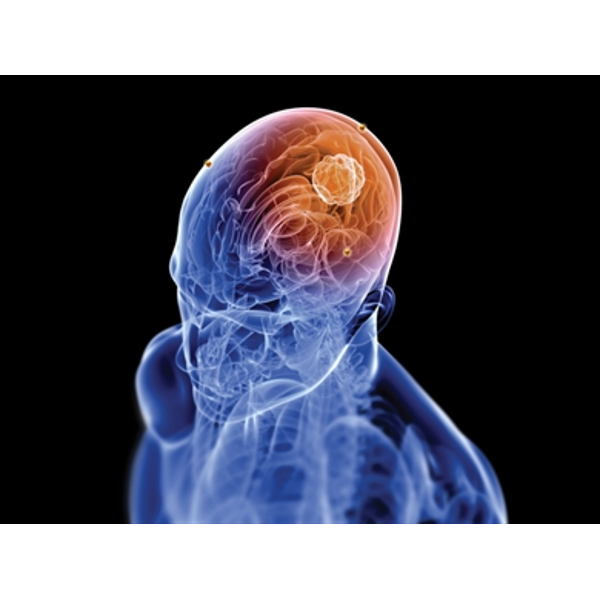 Bone Fiducial Markers