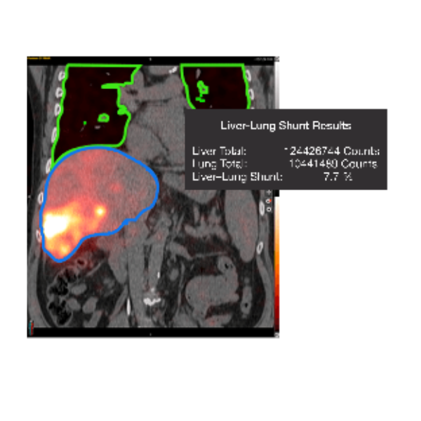 SurePlan™ LiverY90