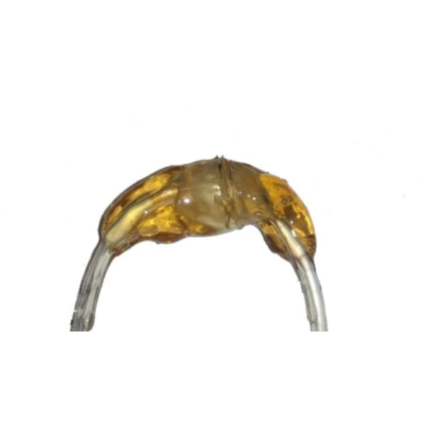 Stenosis And Aneurysm